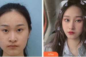 保定普濟(jì)醫(yī)療美容診所張杰整形價格表附眼部綜合案例展示