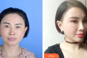 保定珍潤醫(yī)療美容門診部王飛整形價格表附眼部綜合案例展示