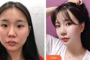 保定珍潤醫(yī)療美容門診部劉軍整形價格表附眼部綜合案例展示