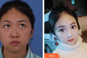 保定新視眼科醫(yī)院唐俊鳳整形價格表附切開雙眼皮案例展示