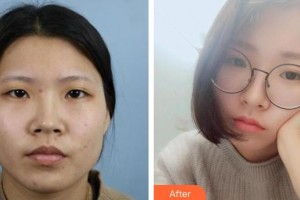 保定藍(lán)山醫(yī)療美容醫(yī)院尹延喜整形價格表附切開雙眼皮案例展示