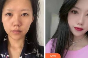 保定新視眼科醫(yī)院馮學(xué)峰整形價格表附眼部綜合案例展示