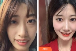 中山愛思特美容醫(yī)院　徐博整形價格表附牙齒矯正案例展示