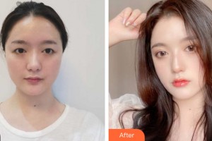 中山百佳婦產(chǎn)醫(yī)院醫(yī)療美容科古嘉強(qiáng)整形價格表附眼部手術(shù)案例展示