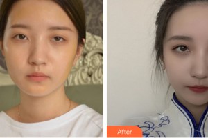 中山美爾醫(yī)療美容門診部權(quán)容現(xiàn)整形價格表附自體脂肪填充案例展示