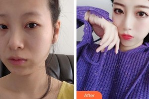 保定藍山醫(yī)療美容醫(yī)院張素芬整形價格表附埋線提升案例展示