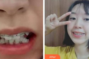 保定東陽口腔醫(yī)院興磊整形價格表附牙齒陶瓷矯正案例展示