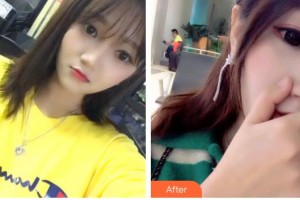 保定東陽口腔醫(yī)院白小青整形價格表附超聲波潔牙案例展示