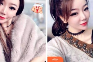 保定東陽口腔醫(yī)院趙晨整形價格表附牙齒隱形矯正案例展示