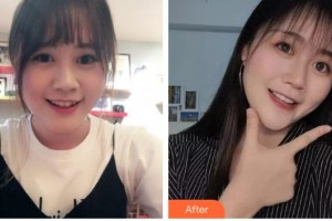 保定市口腔醫(yī)院金永強整形價格表附金屬托槽矯正案例展示