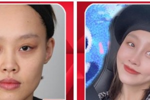 張家口市第四醫(yī)院整形美容科王志剛整形價格表附假體隆鼻案例展示