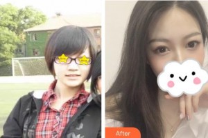 張家口維多利亞醫(yī)療美容醫(yī)院張立平整形價格表附硅膠隆鼻案例展示