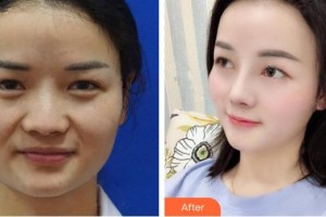 張家口維多利亞醫(yī)療美容醫(yī)院譚亞君整形價格表附鼻部綜合案例展示