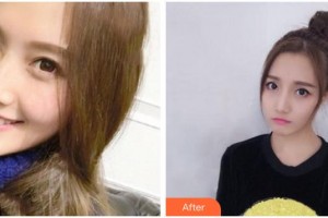 張家口維多利亞醫(yī)療美容醫(yī)院喻輝整形價格表附埋線提升案例展示