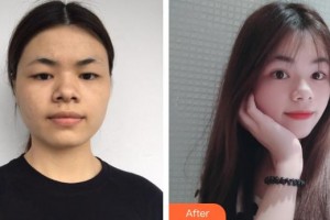 承德星范整形美容醫(yī)院李琳整形價格表附眼部綜合案例展示