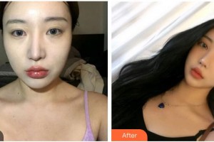 承德愛爾眼科醫(yī)院張節(jié)茹整形價格表附切開雙眼皮案例展示