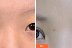 承德名媛醫(yī)療美容門診部崔春曉整形價格表附眼部綜合案例展示