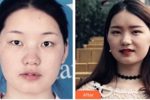 承德醫(yī)學(xué)院附屬醫(yī)院燒傷整形科孫奎整形價格表附定點(diǎn)雙眼皮案例展示