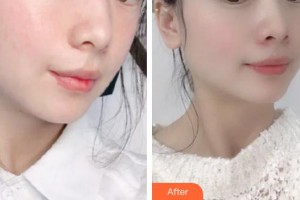 承德玥萊美醫(yī)療美容醫(yī)院齊顯龍整形價格表附激光美膚激光案例展示