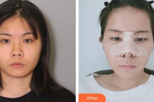 承德美天醫(yī)療美容醫(yī)院整形價格表附鼻部綜合案例展示
