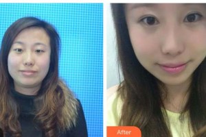 承德愛爾眼科醫(yī)院孟麗梅整形價格表附眼部綜合案例展示