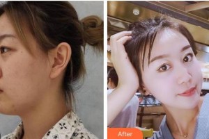 承德愛爾眼科醫(yī)院韓占南整形價格表附眼部綜合案例展示