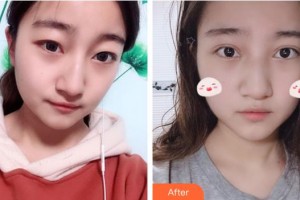 承德愛爾眼科醫(yī)院蘇暢整形價格表附眼部綜合案例展示