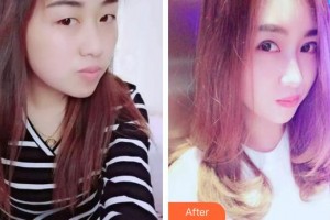 承德朝聚眼科醫(yī)院張鐵民整形價格表附切開雙眼皮案例展示