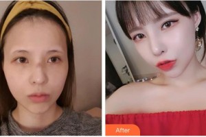 承德美天醫(yī)療美容醫(yī)院王雪艷整形價格表附眼部綜合案例展示