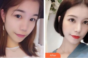 承德朝聚眼科醫(yī)院王占平整形價格表附眼部綜合案例展示