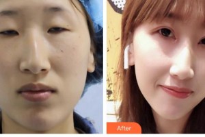 承德朝聚眼科醫(yī)院池忠艷整形價格表附眼部綜合案例展示