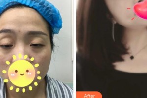 承德朝聚眼科醫(yī)院周海生整形價格表附眼部綜合案例展示