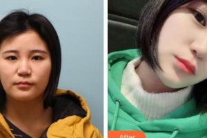 承德朝聚眼科醫(yī)院肖莉整形價格表附埋線雙眼皮案例展示