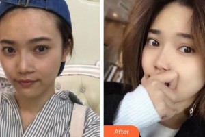 承德玥萊美醫(yī)療美容醫(yī)院楊鵬整形價格表附切開雙眼皮案例展示