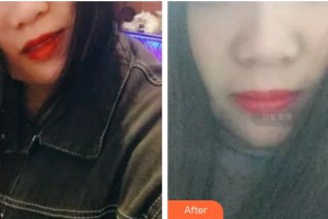 承德玥萊美醫(yī)療美容醫(yī)院韓永剛中心院長整形價格表附超聲波潔牙案例展示