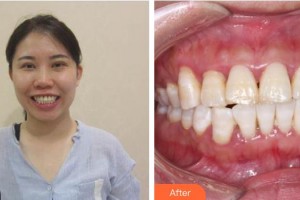 承德愛爾眼科醫(yī)院王明月整形價格表附牙齒隱形矯正案例展示