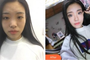 滄州瑞美醫(yī)療美容門診部徐威強(qiáng)整形價格表附假體隆鼻案例展示