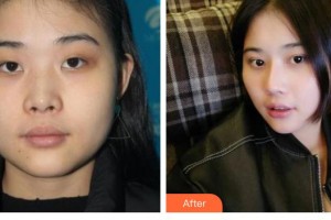 滄州靜港醫(yī)療美容診所鄭祥奎整形價格表附鼻部綜合案例展示