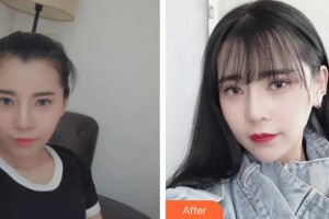 滄州瑞美醫(yī)療美容門診部胡勁松整形價格表附肋軟骨隆鼻案例展示