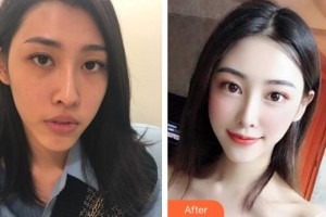 滄州奧拉克醫(yī)療美容醫(yī)院樸根范整形價格表附鼻部綜合案例展示