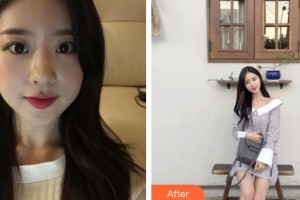 滄州中西醫(yī)結(jié)合醫(yī)院醫(yī)學(xué)美容整形科褚國華整形價格表附鼻部綜合案例展示