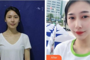 滄州瑞美醫(yī)療美容門診部王波整形價格表附鼻部綜合案例展示