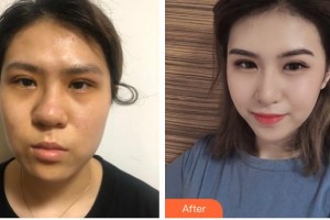 滄州瑞美醫(yī)療美容門診部牛永敢整形價格表附假體隆鼻案例展示