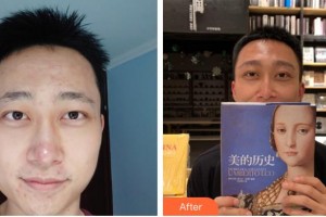 滄州華美醫(yī)療美容醫(yī)院宋石磊整形價格表附植發(fā)案例展示