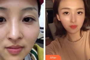 滄州華美醫(yī)療美容醫(yī)院陳遠(yuǎn)琨整形價格表附鼻部綜合案例展示