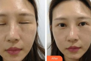 滄州靜港醫(yī)療美容診所路永洋整形價格表附眼部修復(fù)案例展示