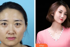 滄州眼科醫(yī)院周暢達(dá)整形價格表附切開雙眼皮案例展示