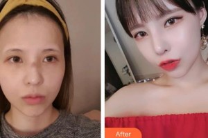 滄州華美醫(yī)療美容醫(yī)院白偉楓院長整形價格表附切開雙眼皮案例展示