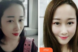 滄州眼科醫(yī)院韓二杰整形價格表附切開雙眼皮案例展示