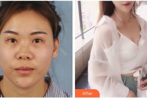 滄州眼科醫(yī)院張立友整形價格表附定點雙眼皮案例展示